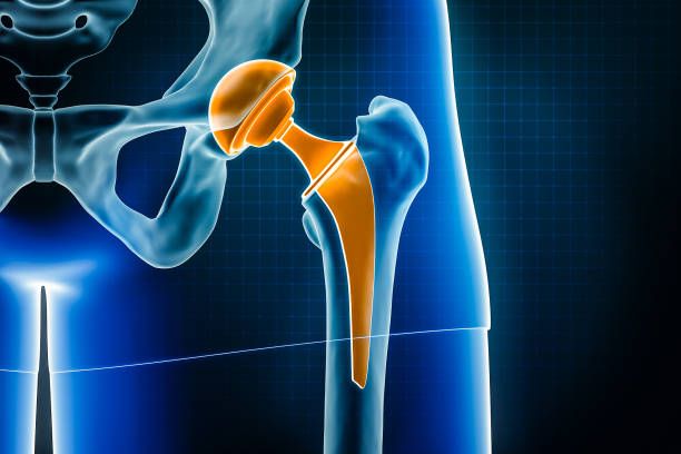 What happens before, during and after Joint replacement?