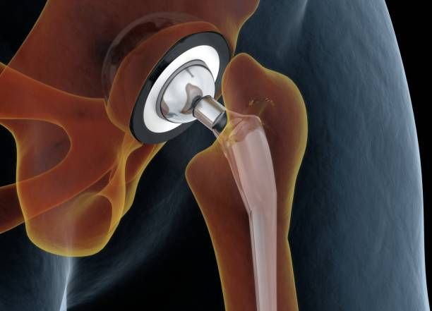 The risks of Joint replacement