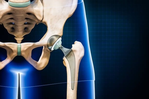 Who needs Hip arthroplasty?