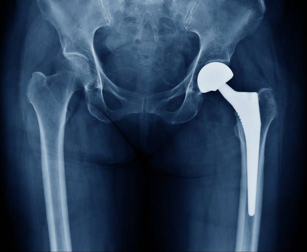 Hip arthroplasty restrictions