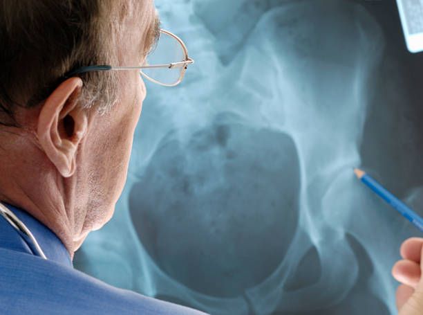 The benefits of Hip arthroplasty