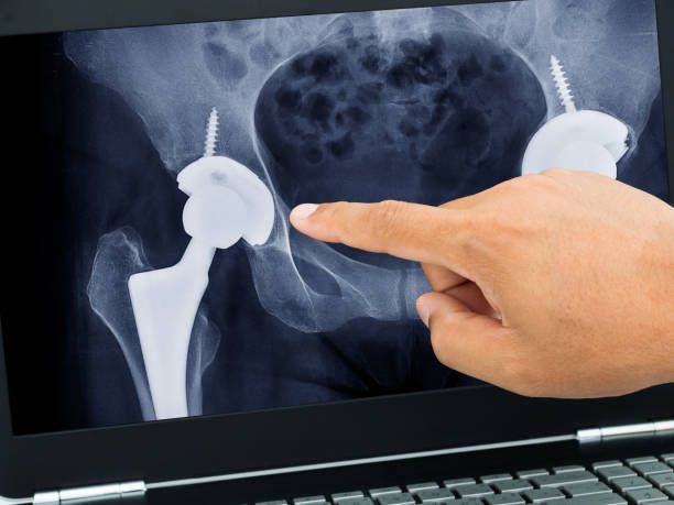 Hip arthroplasty recovery