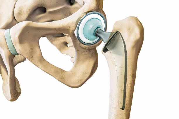 Hip arthroplasty cost in Iran