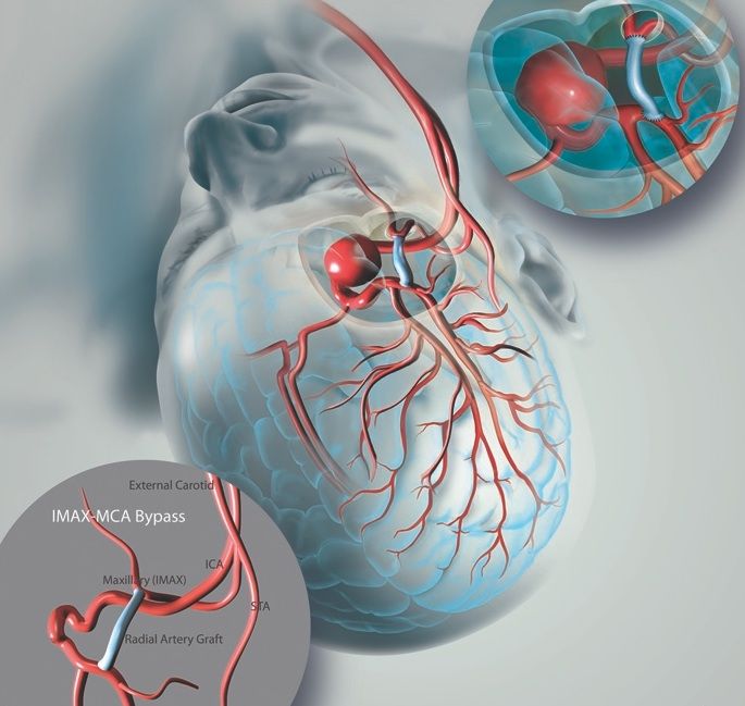 Cerebrovascular disease symptoms