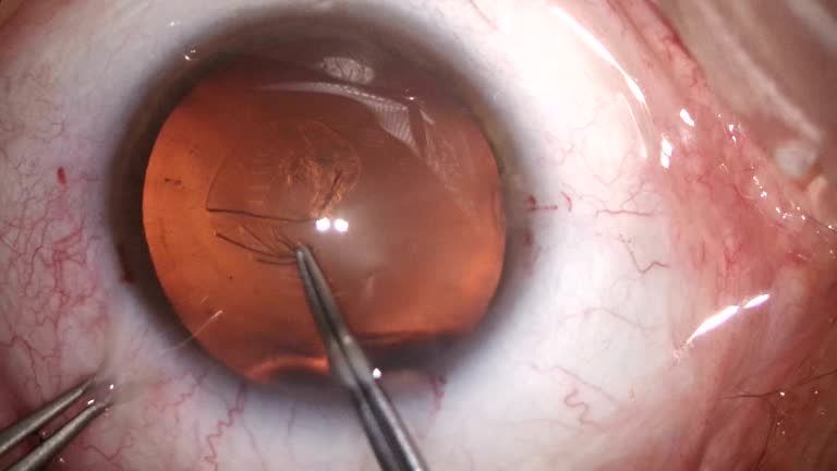 Why is Retinal Surgery performed?