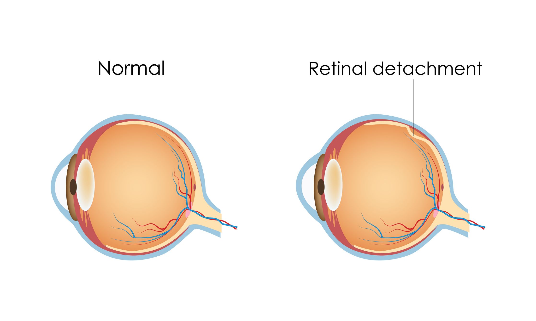 What is retinal detachment?