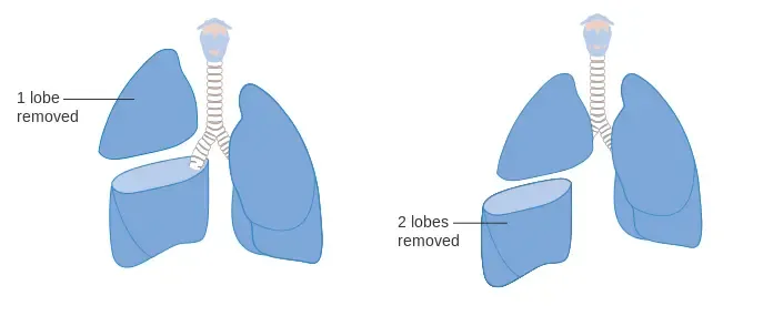 Types of Lobectomy Procedures