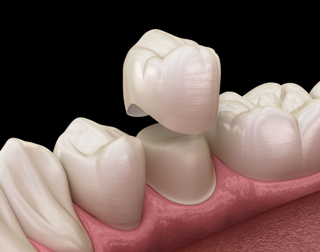 What is a dental crown?