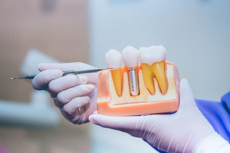 The benefits of dental crowns