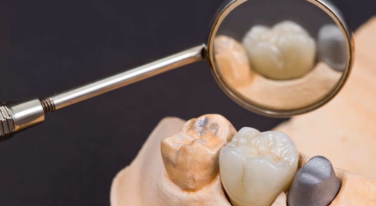 The disadvantages of dental crowns