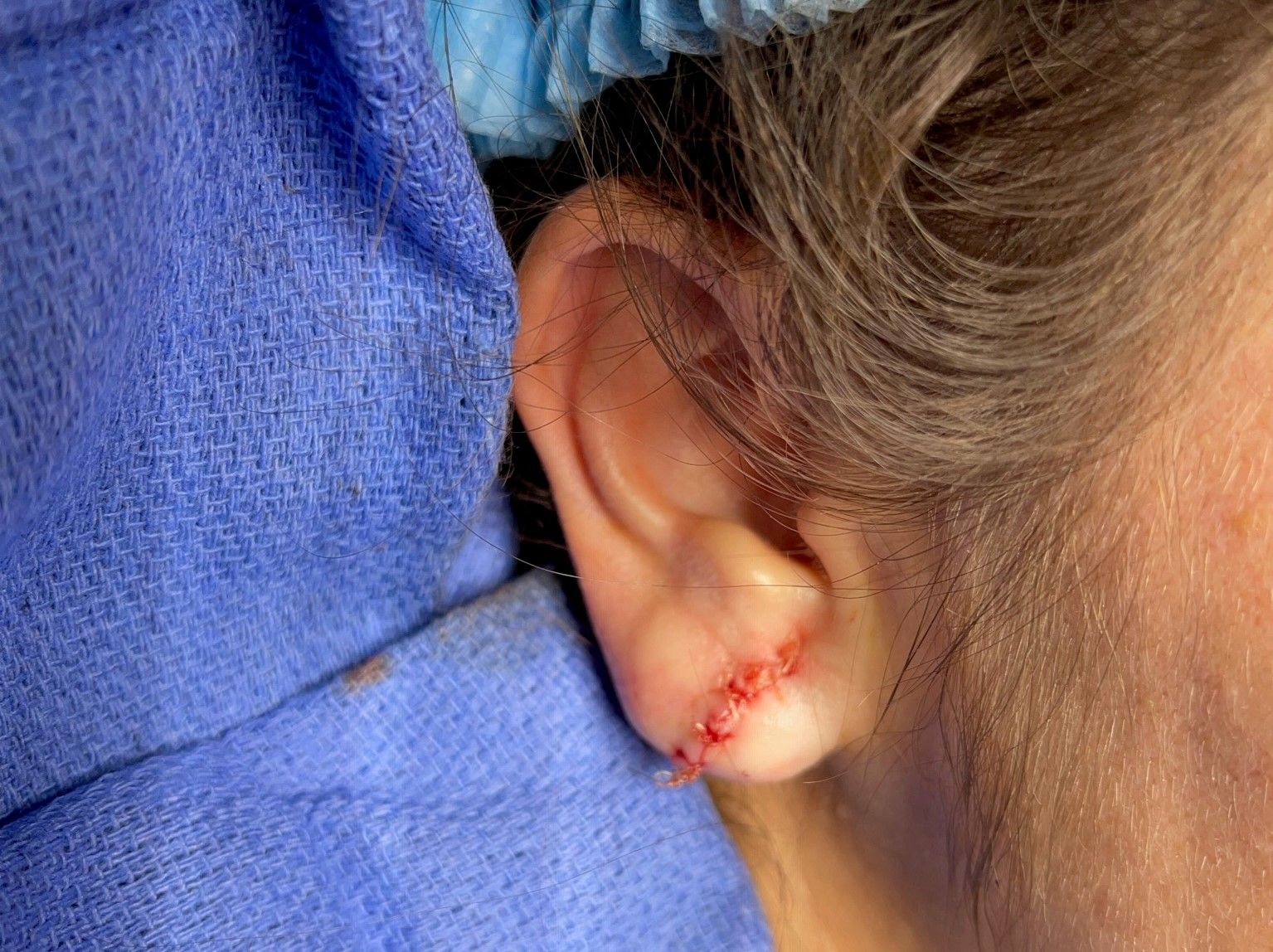 Ear lobe repair