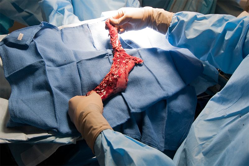 Why is Esophagectomy performed?