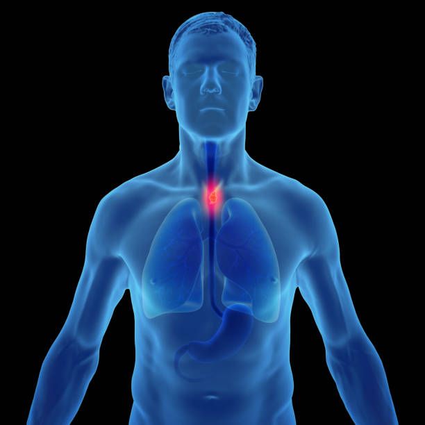 Esophagectomy cost in Iran