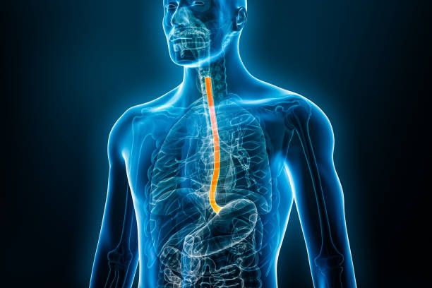 Esophagectomy side effects