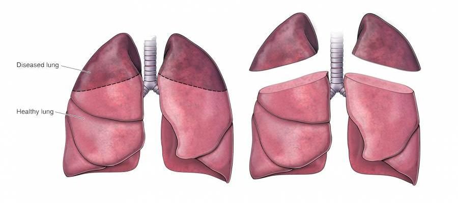 What is Lung Volume reduction surgery?