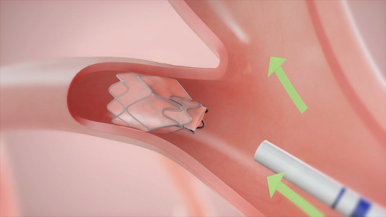 Lung Volume reduction surgery techniques