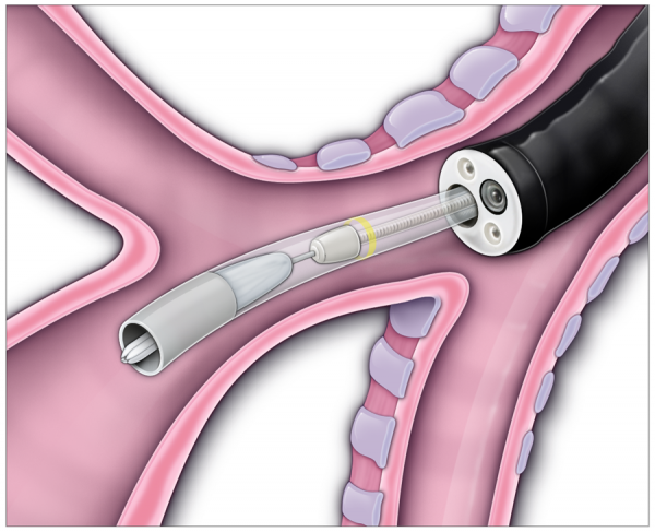 Lung Volume reduction surgery survival rates