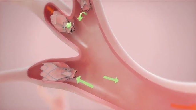 Lung Volume reduction surgery cost in Iran