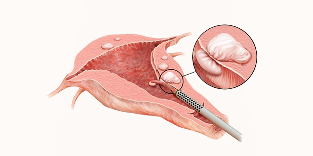 Endometrial ablation