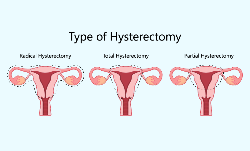 Hysterectomy