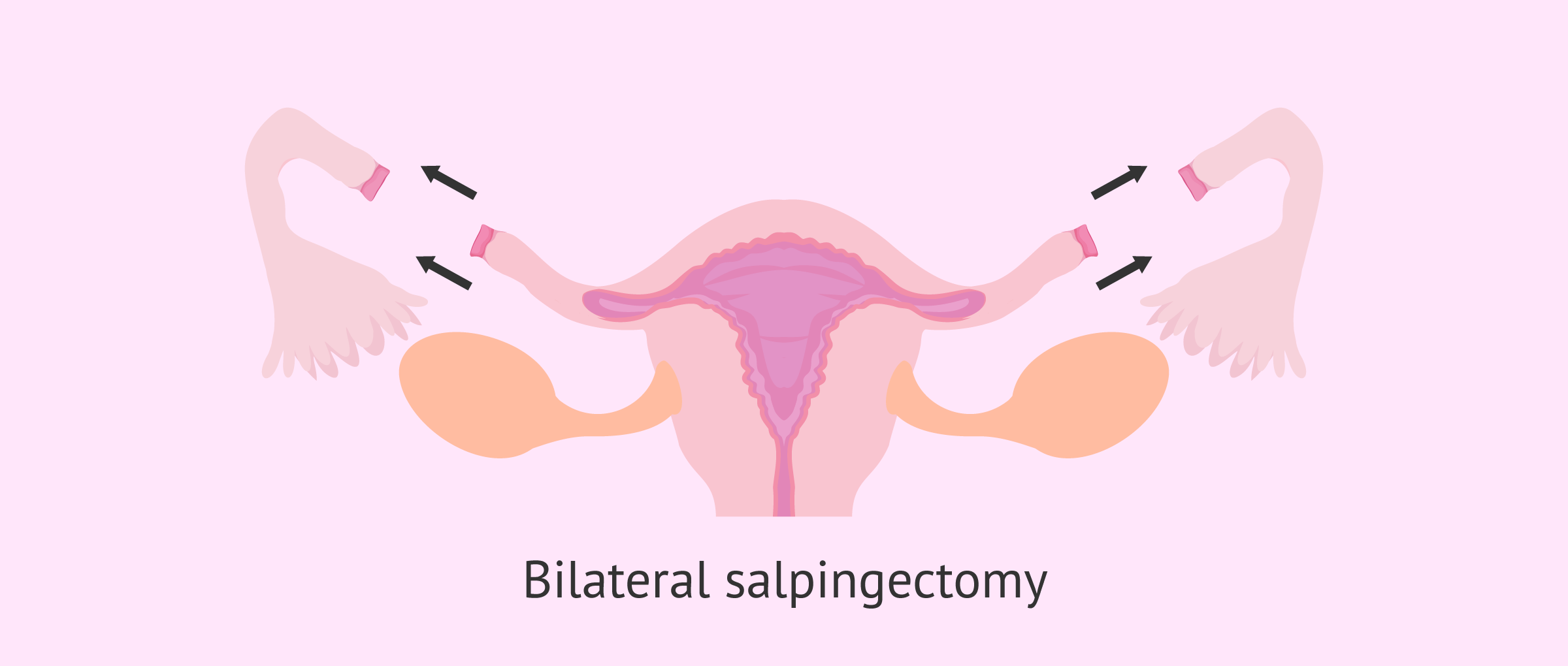 Salpingectomy