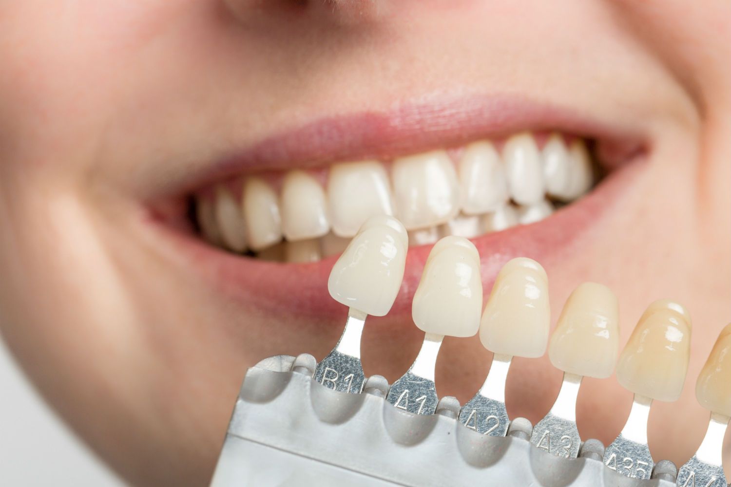 Veneers vs. Crowns