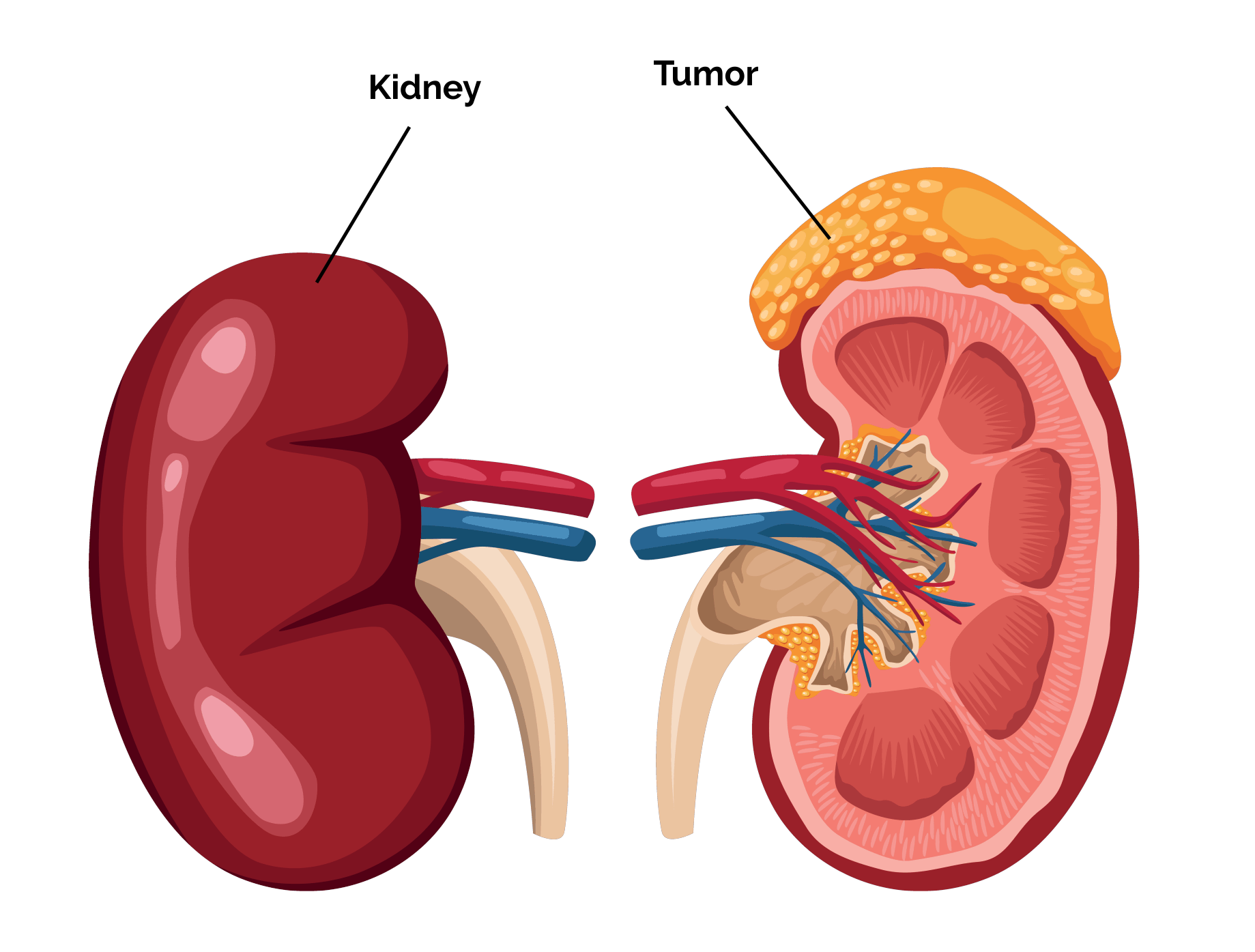 Why is kidney removal done?