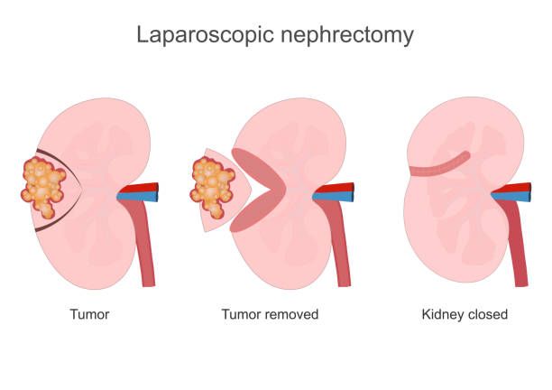 Nephrectomy advantages