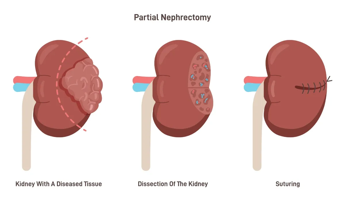 Nephrectomy disadvantages