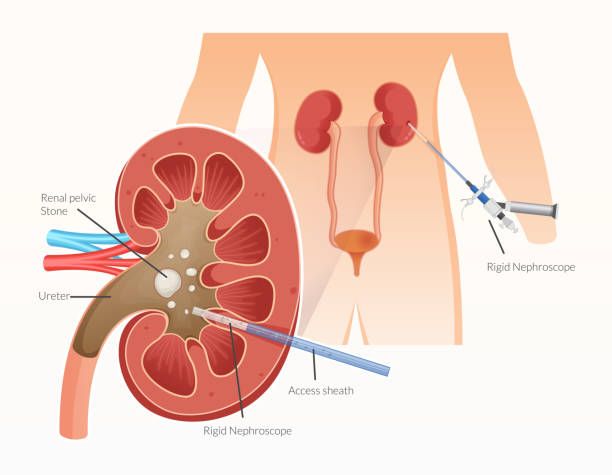 Nephrectomy cost in Iran