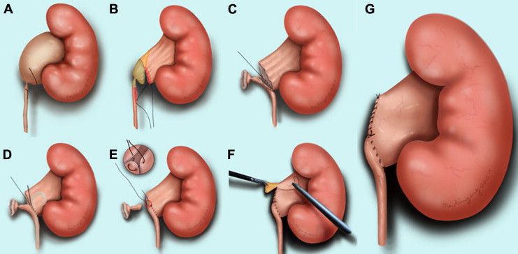 Pyeloplasty surgery steps