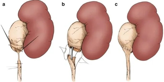 Pyeloplasty Risks