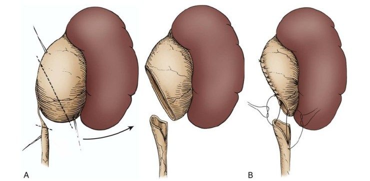 Pyeloplasty cost in Iran