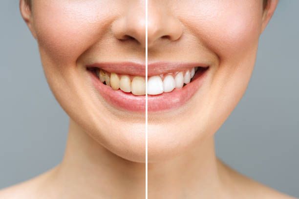 Benefits of Teeth Whitening