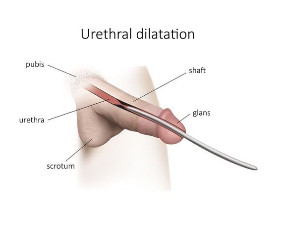 Who needs Urethral surgery?