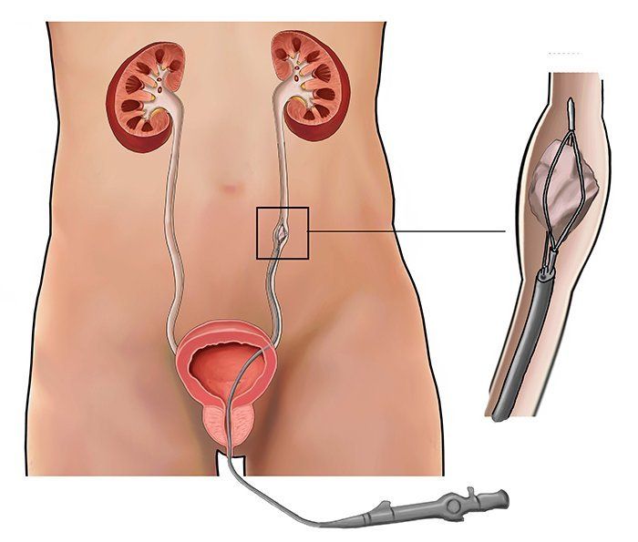 Urethral surgery cost in Iran