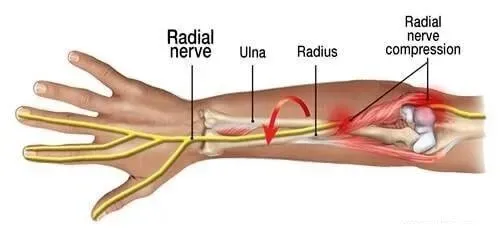 Radial Nerve Injury & Repair