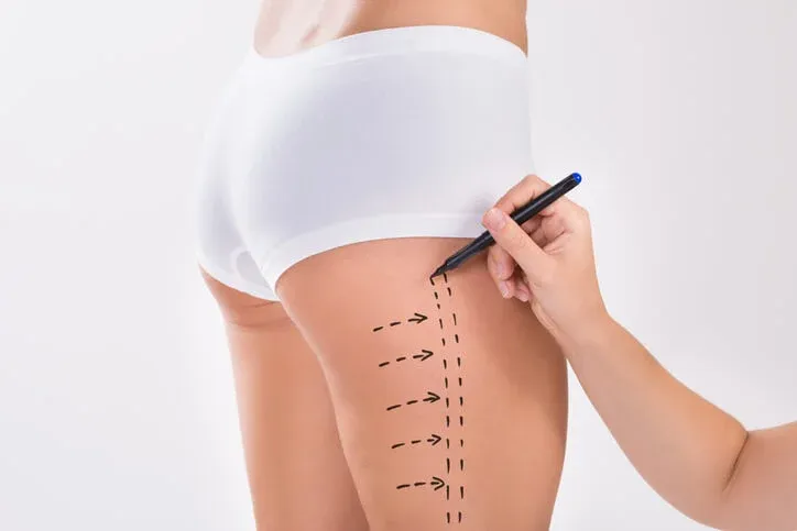 Everything you need to know about Thigh Lift procedure