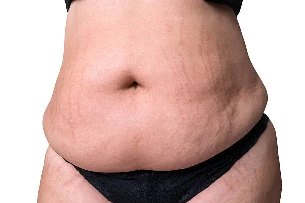 Is Tummy Tuck right for me?