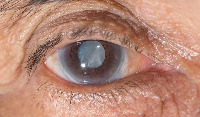 Glaucoma the Chronic Eye Illness