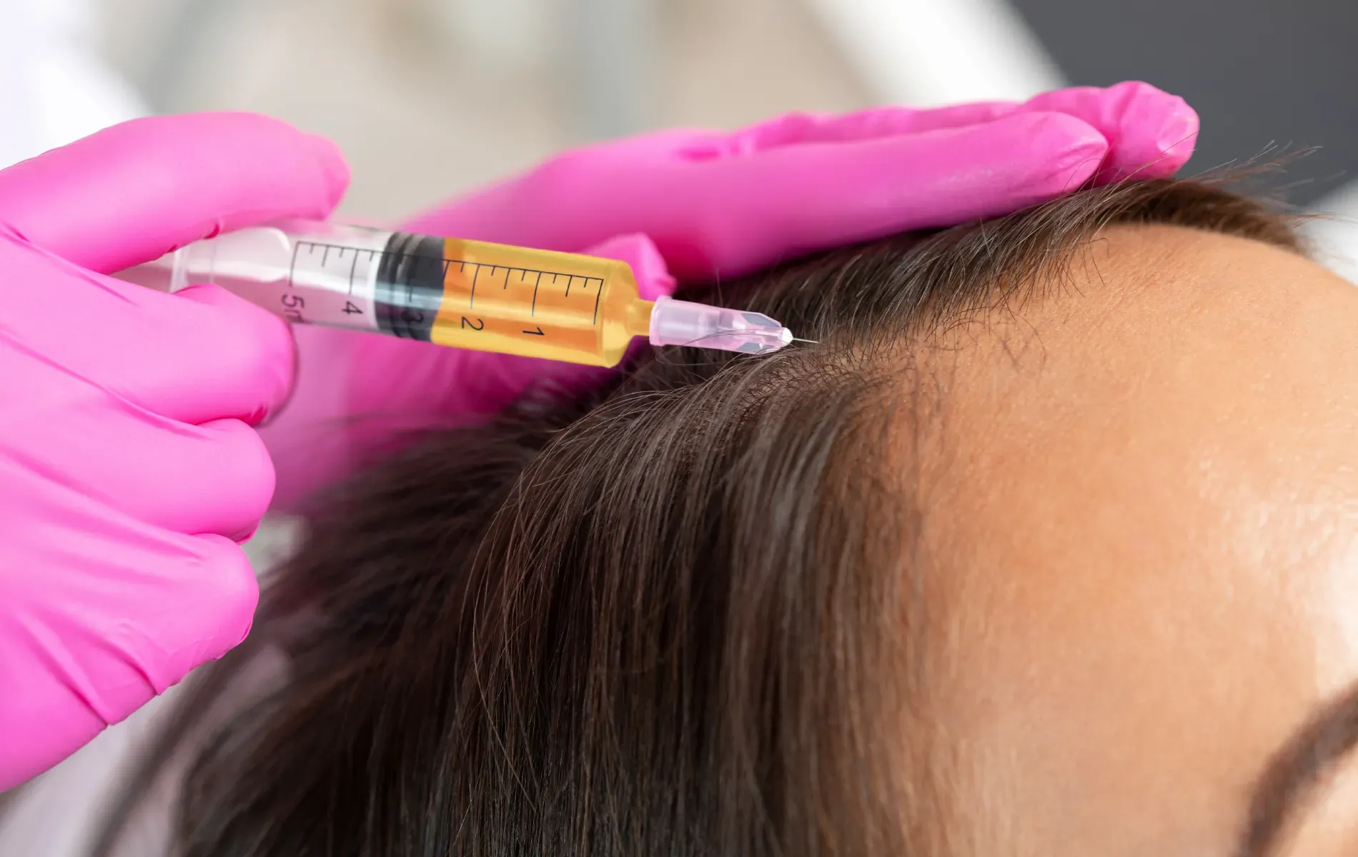 What are Hair Fillers & How do they work?