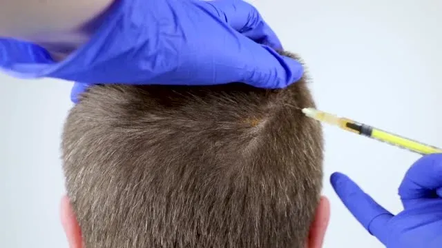 What are the side effects of Hair Transplant?