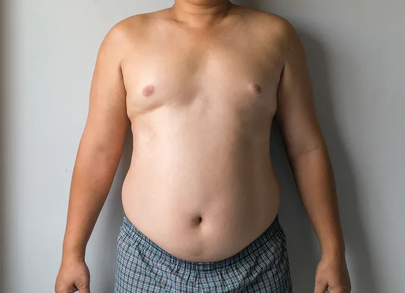 How is Enlarged Male Breast Tissue (Gynecomastia) treated?