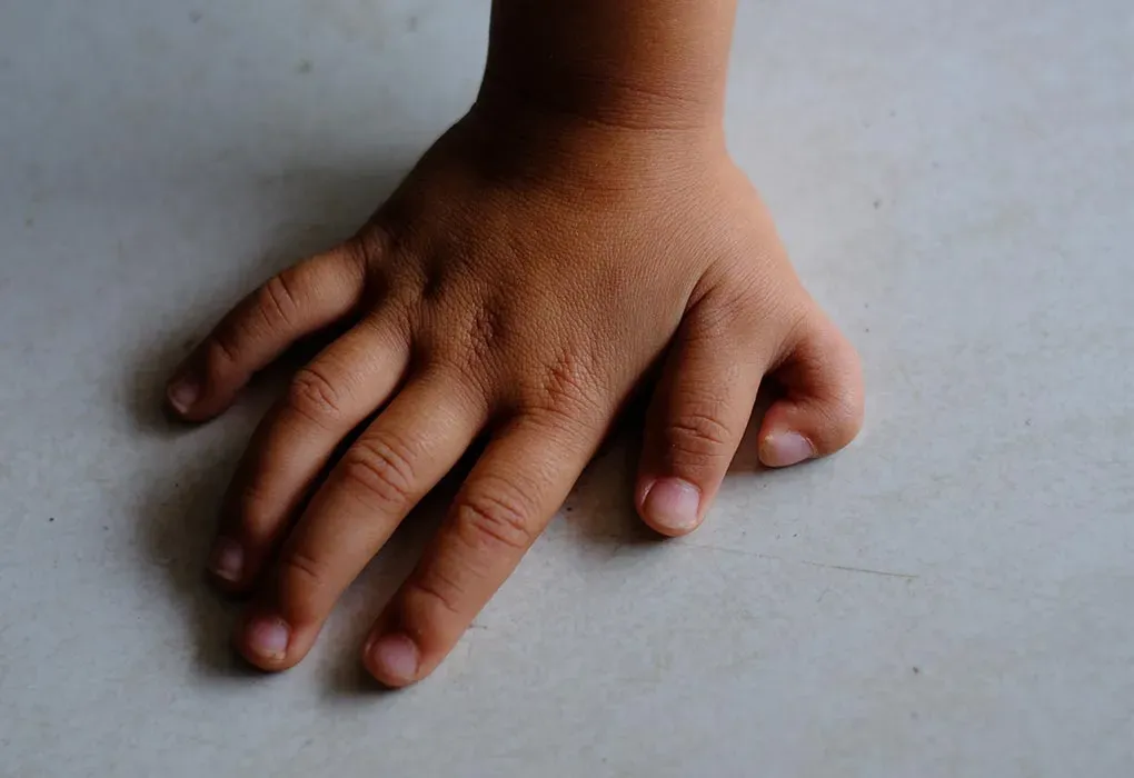 Why does Polydactyly occur & how is it treated?