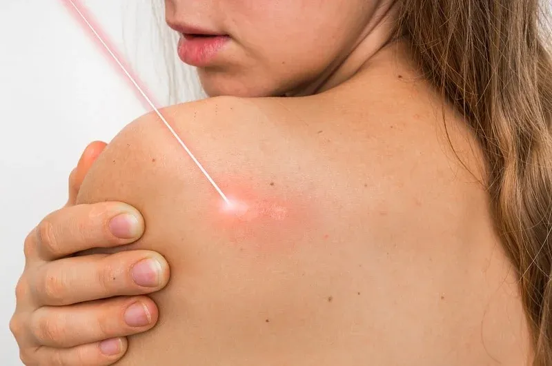 Laser Scar Removal: What you need to know