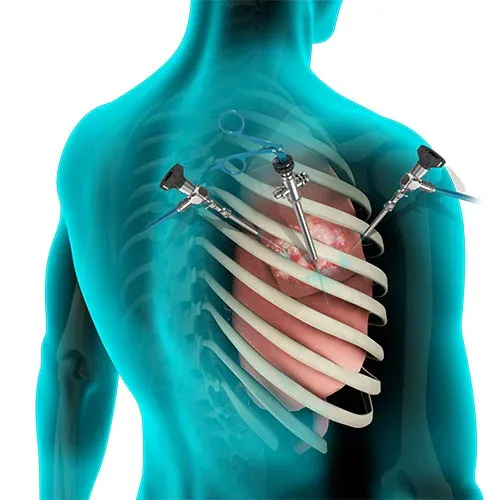 Types of Lung Surgery