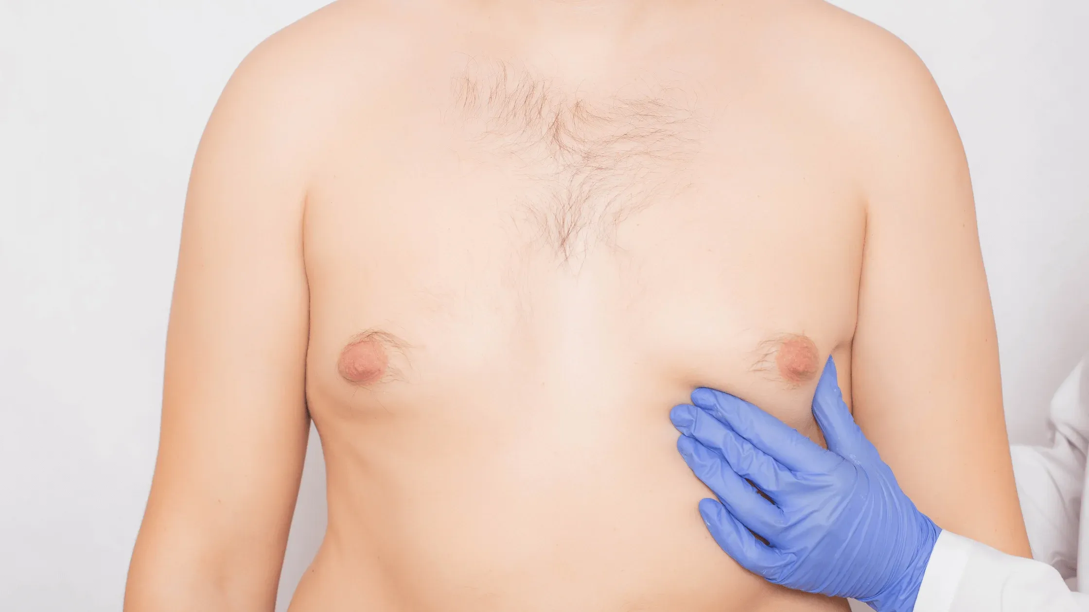 Why is Gynecomastia becoming more common?