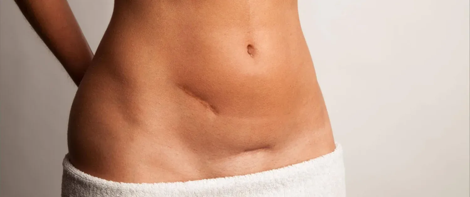 What Are the Best Options for Scar Removal?