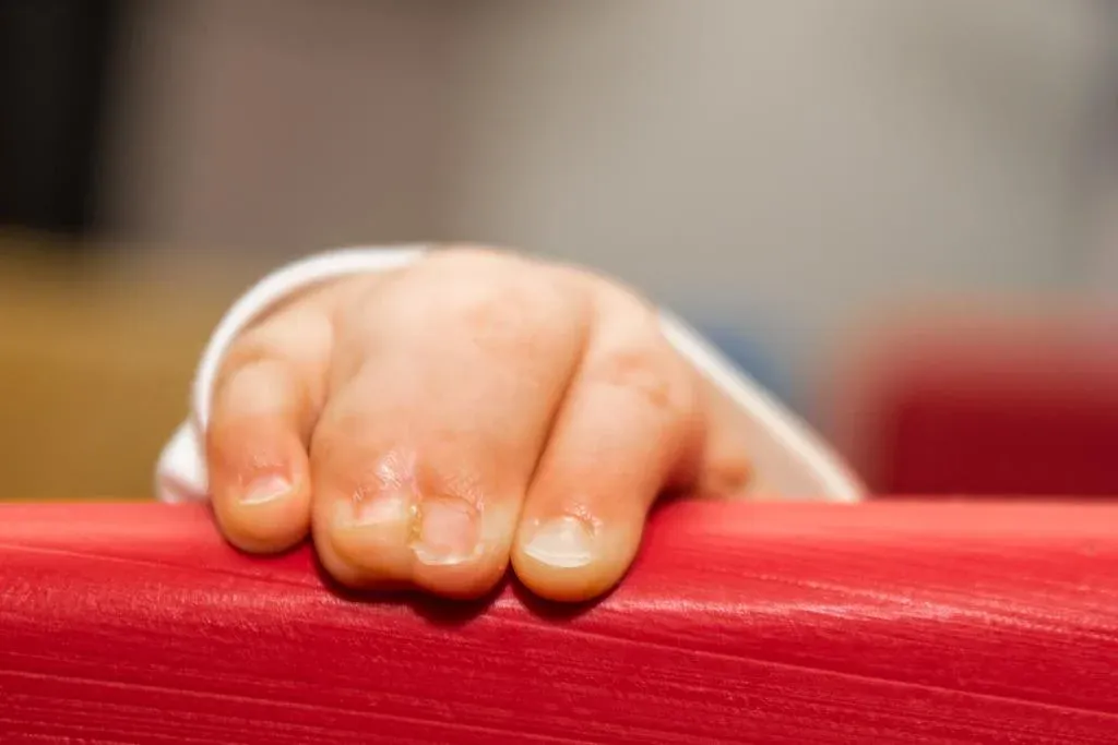 Why does Syndactyly occur & how is it treated?