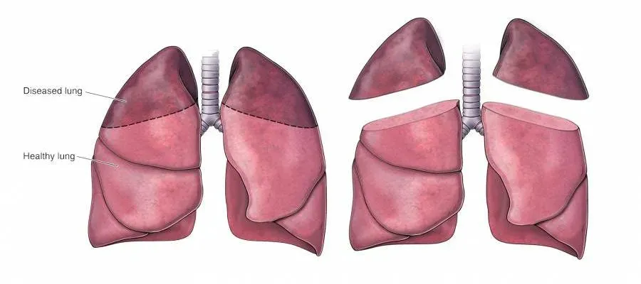 Types of Lung Surgery